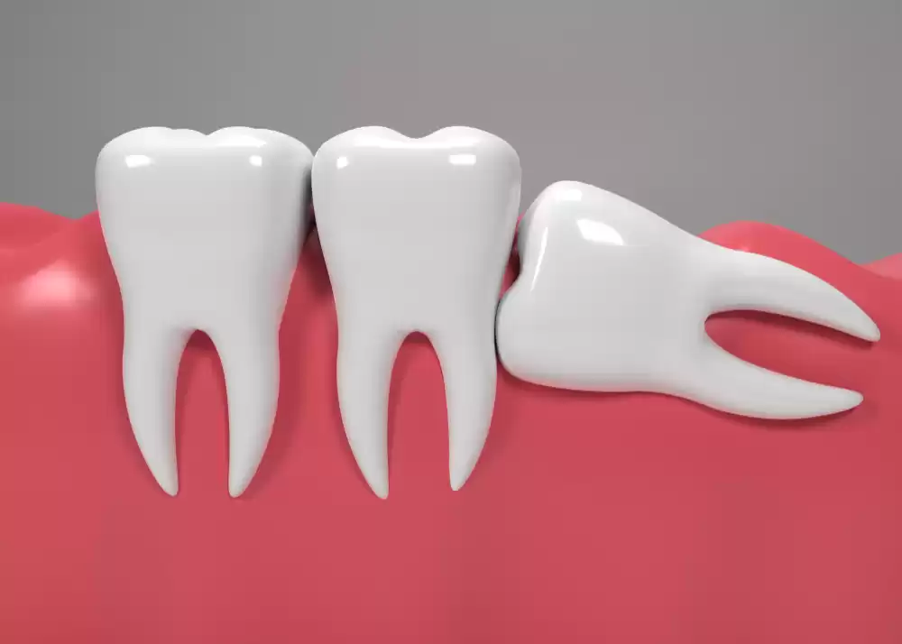 Wisdom Tooth Removal