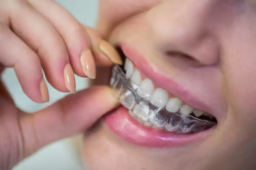 Orthodontic Treatment
