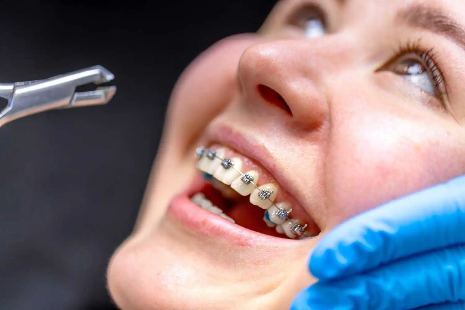Decoding the Dental Braces Cost in Noida